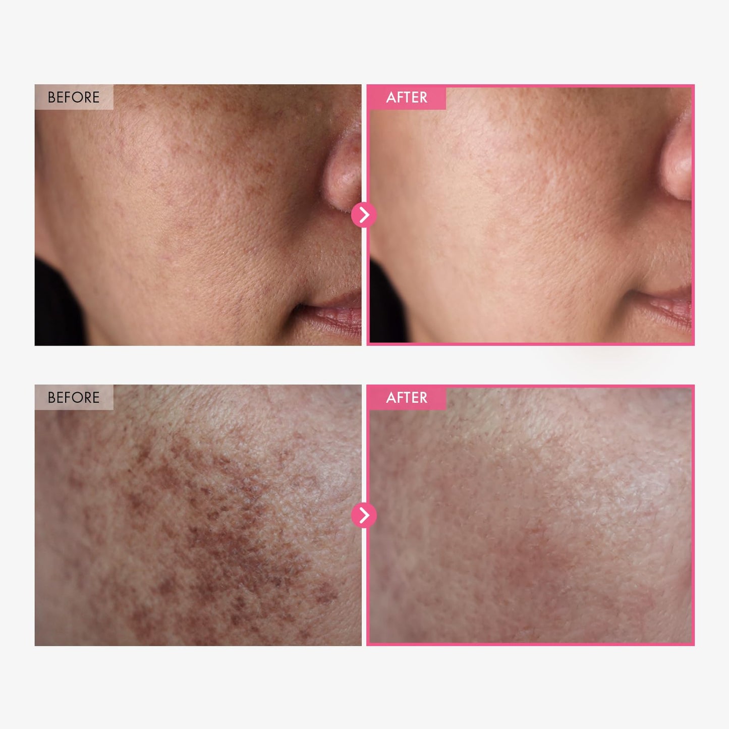 TOSOWOONG Arbutin 7% + Tranexamic Acid 4% Cream, 70,000ppm Arbutin, 40,000ppm TXA, Niacinamide, Glutathione - Maple Wellness Supplements