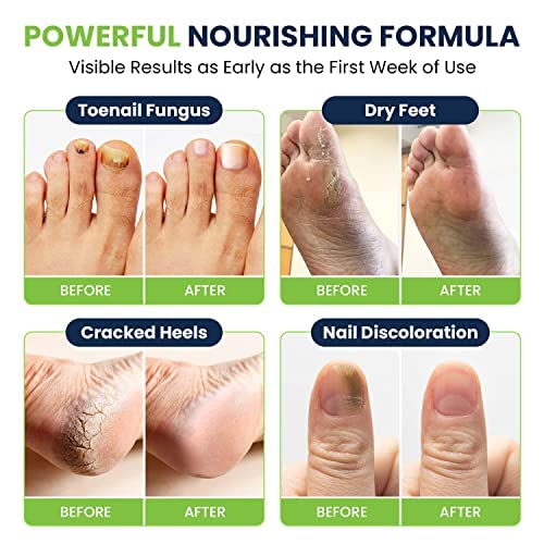Toenail Fungus Treatment Extra Strength - Advance nail fungus treatment for fingernails FOOT CUREBuy Supplements Australia