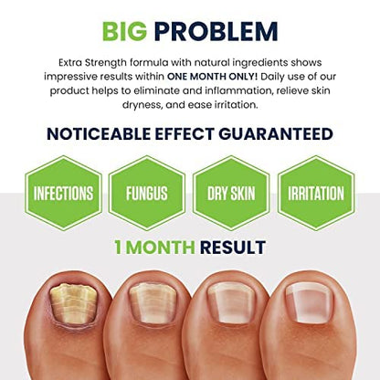 Toenail Fungus Treatment Extra Strength - Advance nail fungus treatment for fingernails FOOT CUREBuy Supplements Australia