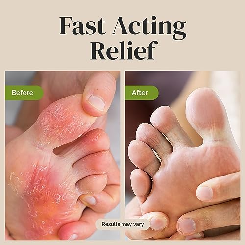 Puriya Tea Tree Oil Antifungal Cream, Plant-Powered Athletes Foot Cream Treatment PuriyaBuy Supplements Australia