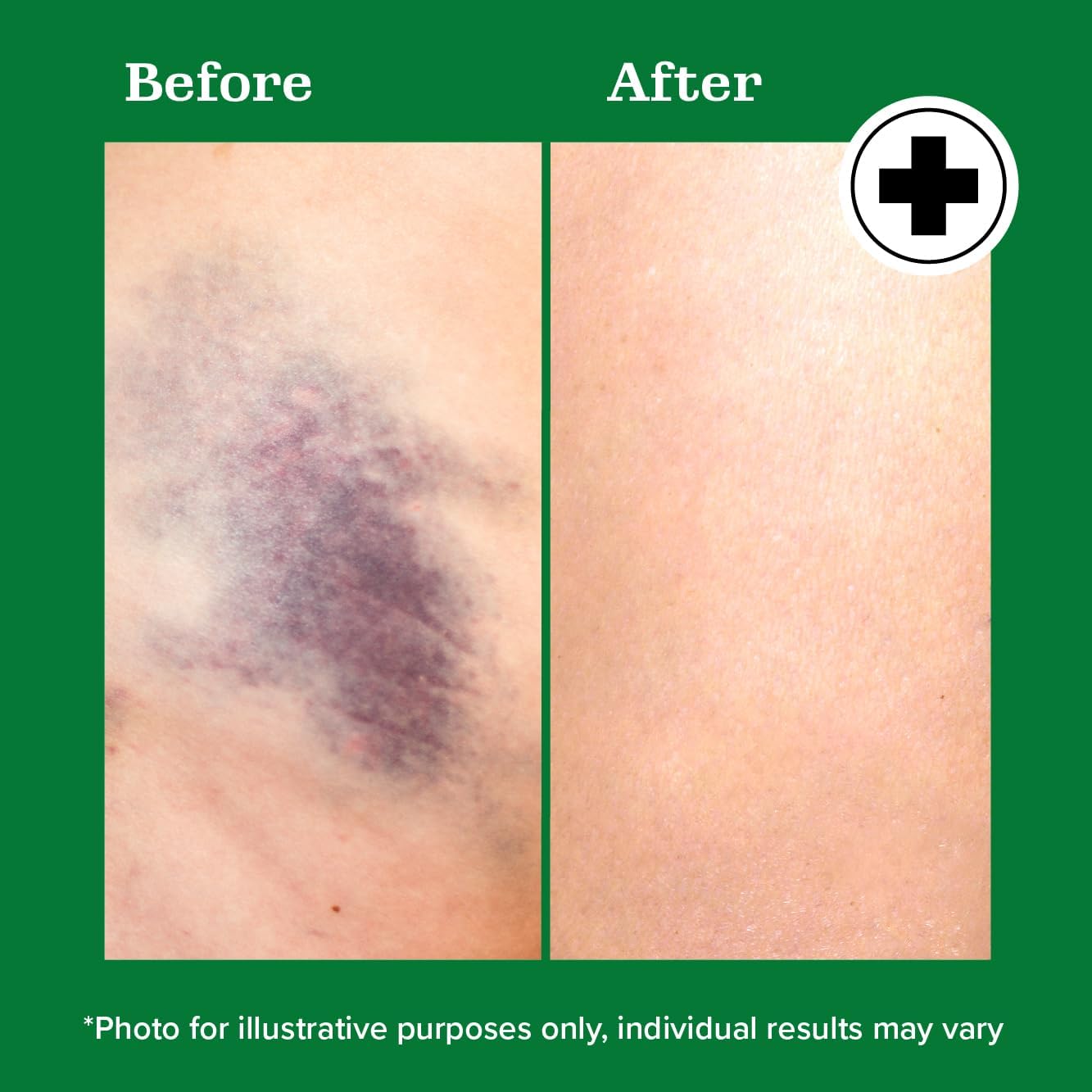 Miracle Plus Natural Arnica Bruise Gel For Body | Skin Care Arnica Montana Lotion Topical Gel | Extra Strength Vitamin K Cream Ointment, 4 Fl Oz Miracle PlusBuy Supplements Australia