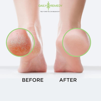 Tea Tree Oil Foot Soak with Epsom Salt - Made in USA - for Toenail Athletes Foot DAILY REMEDYBuy Supplements Australia