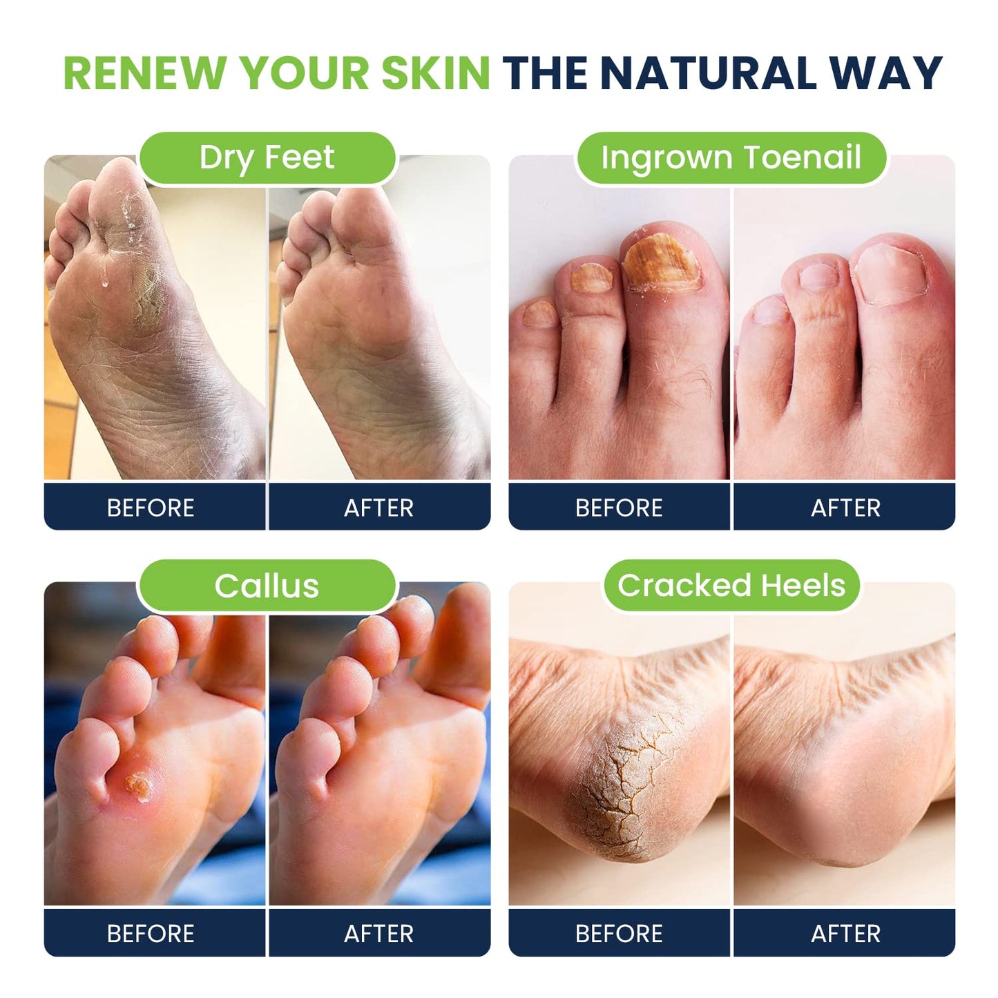 Foot Soak with Epsom Salts- Variety Pack of 4- Tea Tree Oil, Muscle Relief, Calming FOOT CUREBuy Supplements Australia