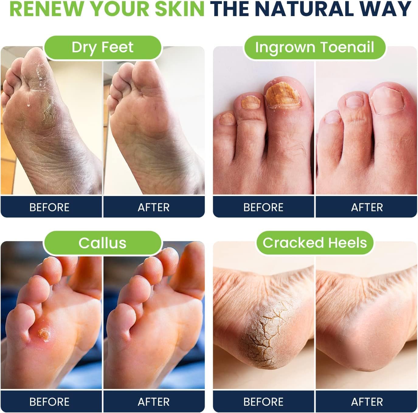 Tea Tree Oil & Citrus Detox Foot Soak with Epsom Salts - All Natural Salts for Post Workout FOOT CUREBuy Supplements Australia
