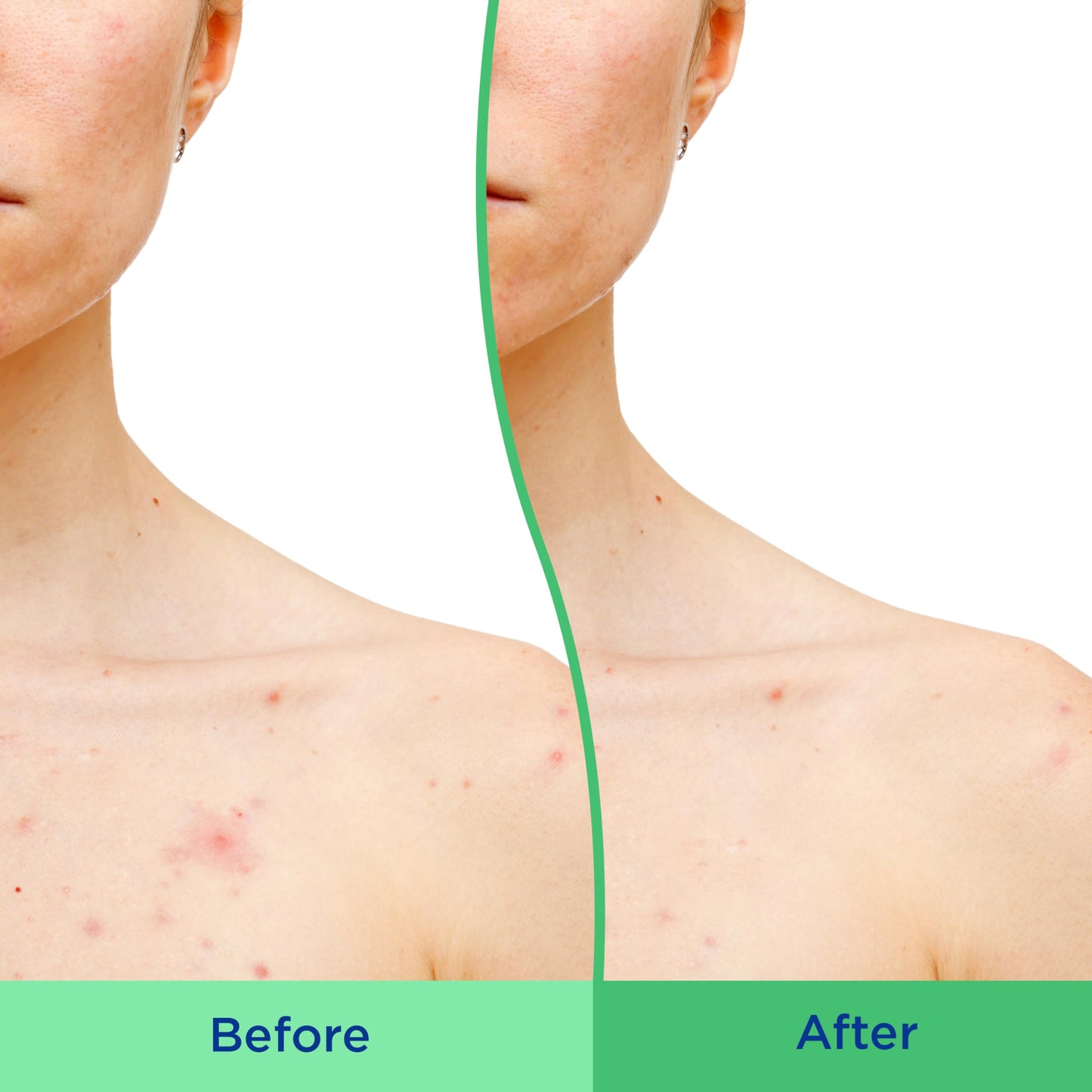 Differin Body Scrub with Salicylic Acid Acne Clearing Improves Tone and Texture Prone Skin DifferinBuy Supplements Australia