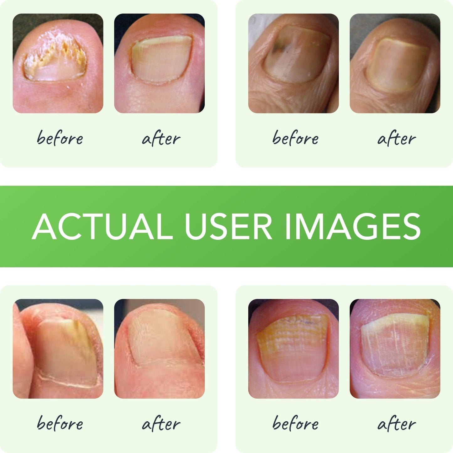 FUNGINIX Healthy Nail Formula - Finger And Toe Fungus Treatment, Made In USA, Foot FUNGINIXBuy Supplements Australia