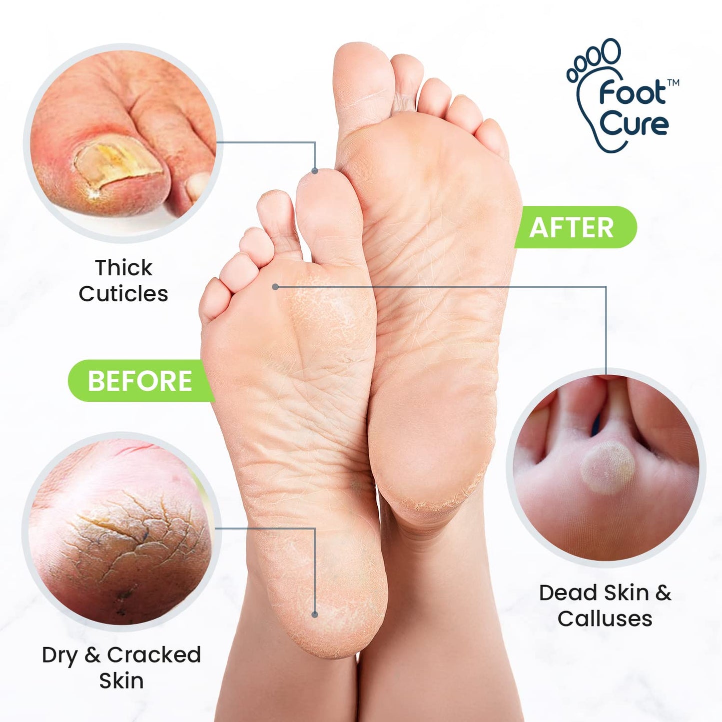 Toenail Fungus Treatment Extra Strength - Advance nail fungus treatment for fingernails FOOT CUREBuy Supplements Australia