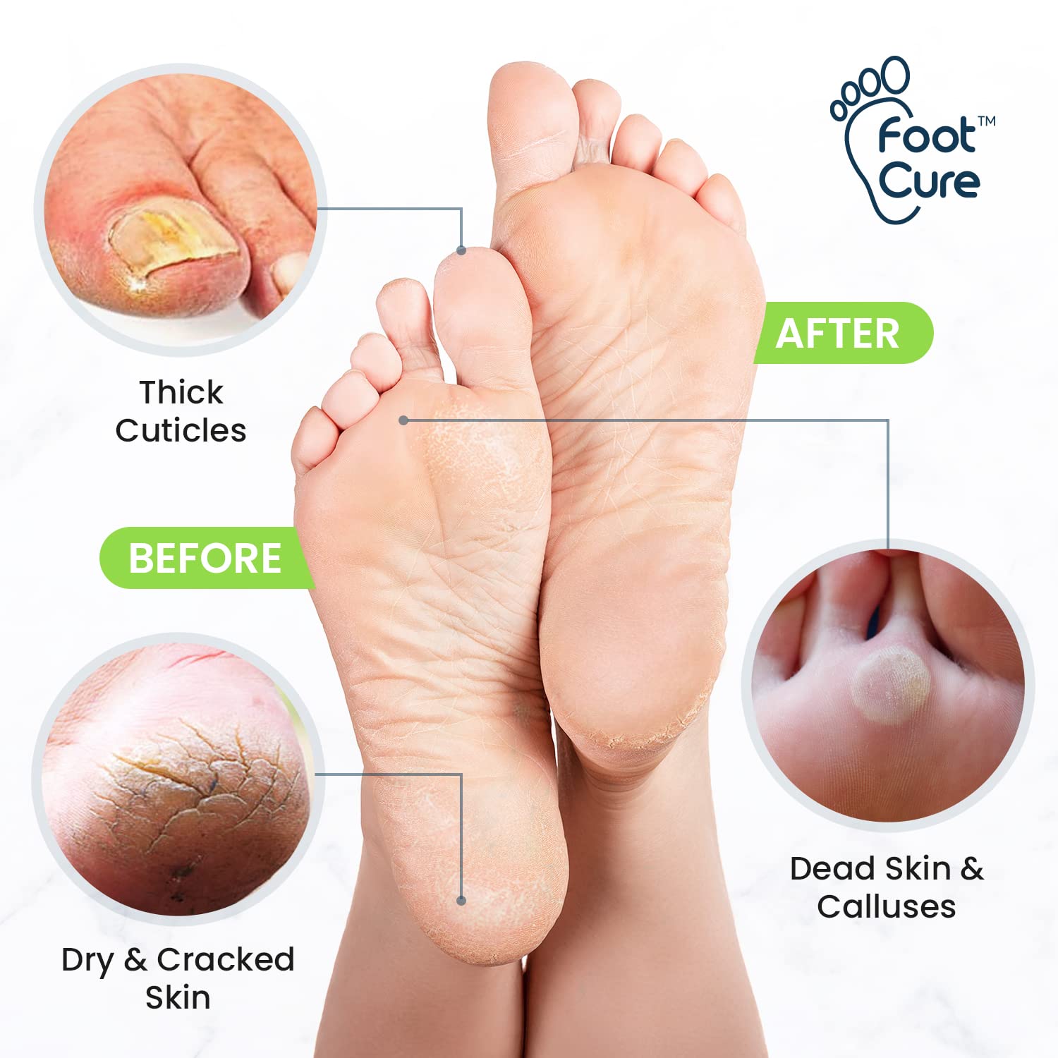 Toenail Fungus Treatment Extra Strength - Advance nail fungus treatment for fingernails FOOT CUREBuy Supplements Australia