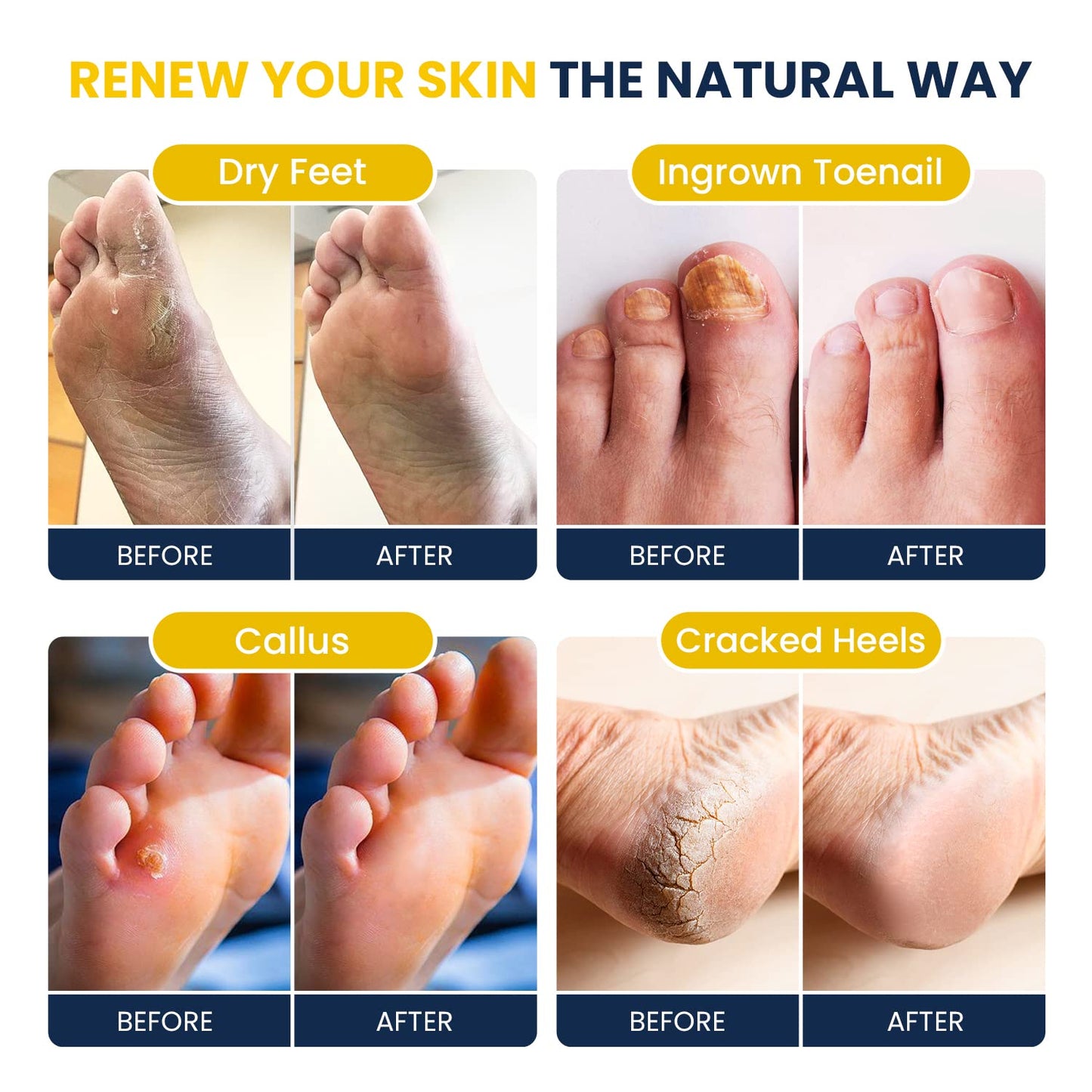 Citrus Detox Foot Soak With Epsom Salts - for Foot Callus, Immune Boost, Damaged Toenail FOOT CUREBuy Supplements Australia