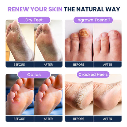 Soothing Lavender Foot Soak with Epsom Salt - Best Toenail Treatment, & Softens Calluses FOOT CUREBuy Supplements Australia