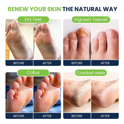Tea Tree Oil Foot Soak with Epsom Salt - Best Toenail Fungus Treatment, Athletes FOOT CUREBuy Supplements Australia