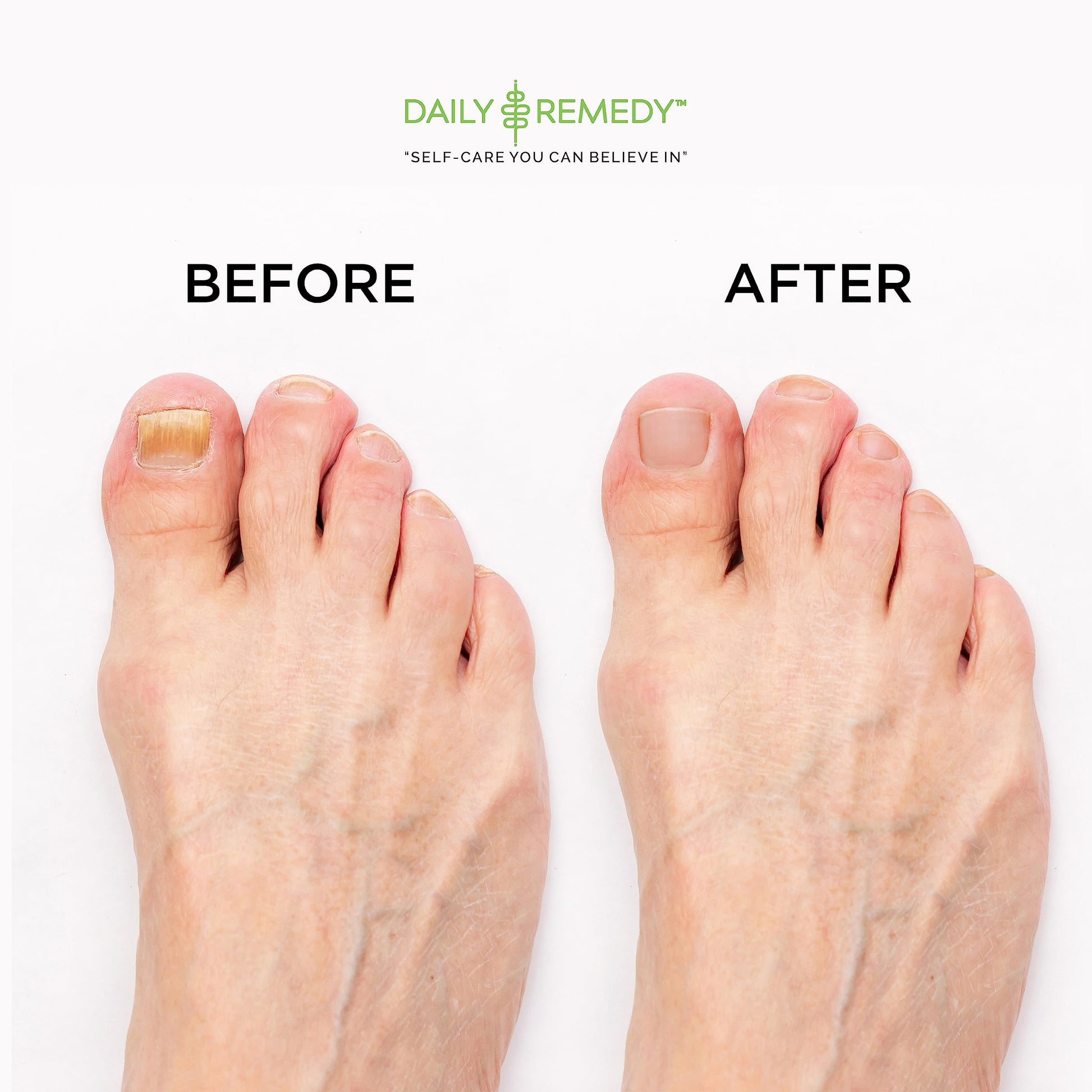 EXTRA STRENGTH Tea Tree Oil Foot Soak with Epsom Salt - Made in USA - for Toenails DAILY REMEDYBuy Supplements Australia