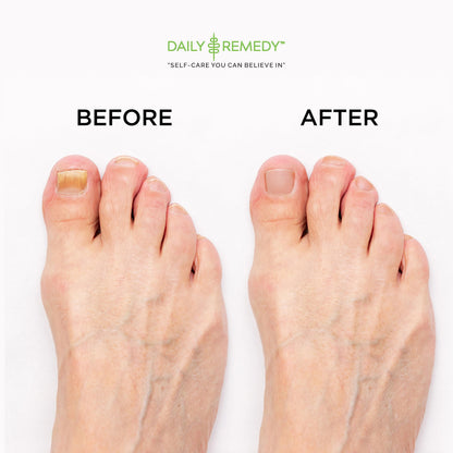 EXTRA STRENGTH Tea Tree Oil Foot Soak with Epsom Salt - Made in USA - for Toenails DAILY REMEDYBuy Supplements Australia