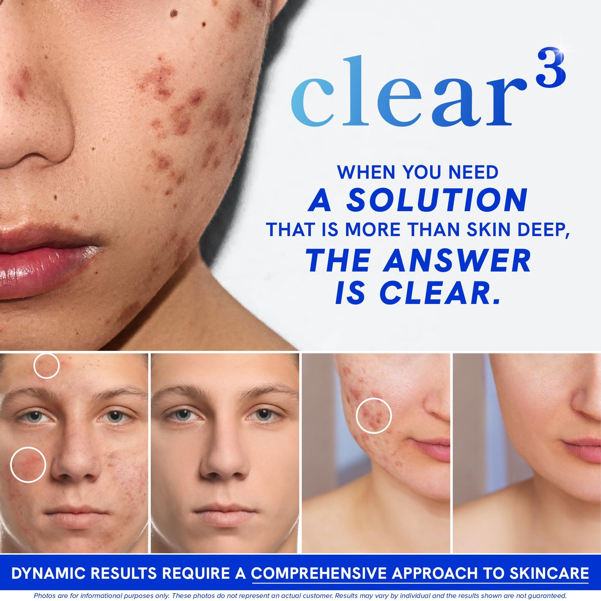 Clear Skin Supplement with Zinc, DIM & Probiotics | 3-in-1 Balance, Glow & Health Skin Support | Triple Action Hyaluronic Acid, Niaciminide & Vitamins for Hormone, Complexion & Gut Support | 180 Ct SMNutritionBuy Supplements Australia