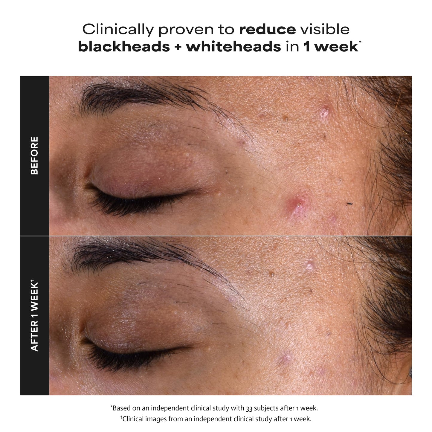 Paulas Choice--SKIN PERFECTING 2% BHA Liquid Salicylic Acid Exfoliant--Facial Exfoliant