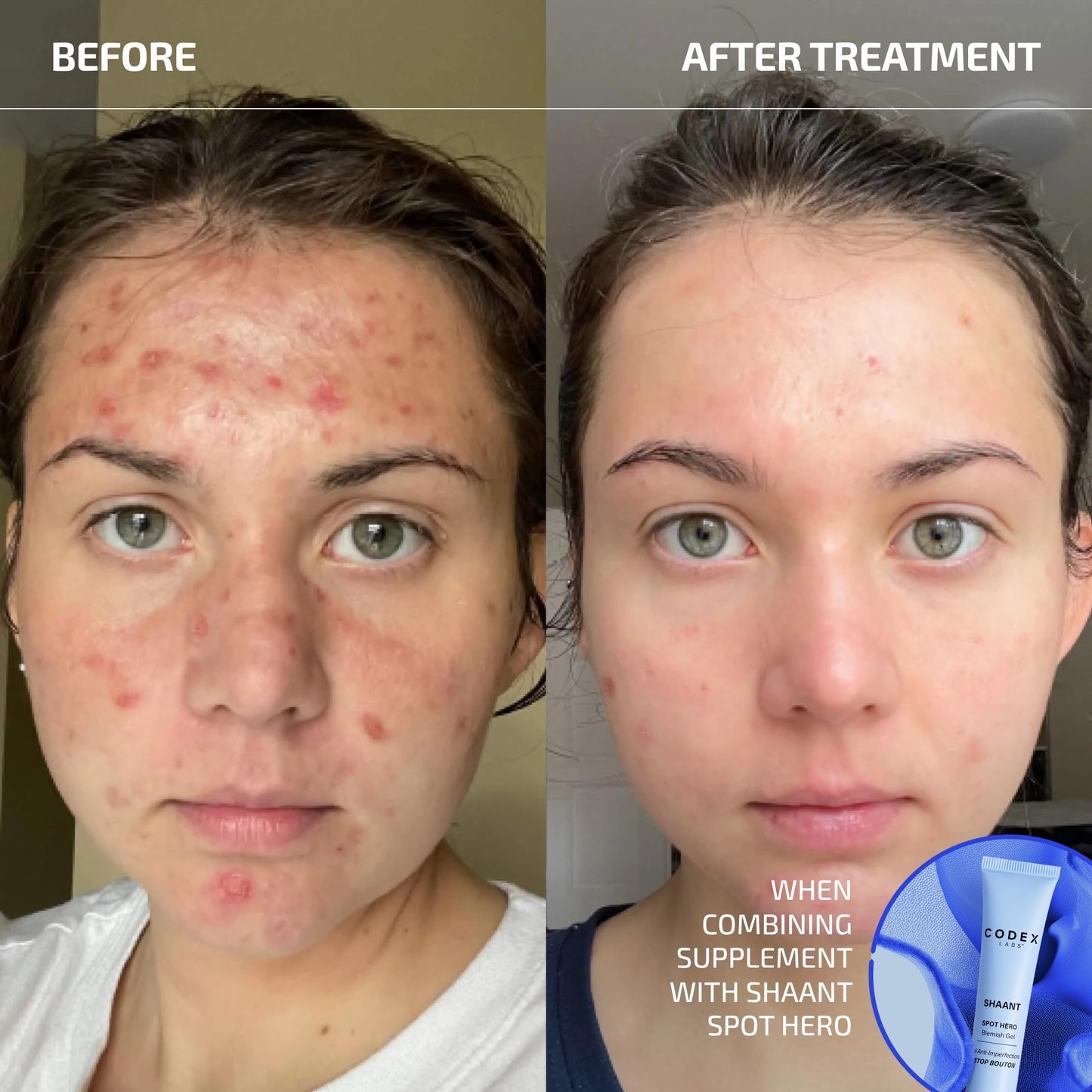 Codex Labs Shaant Clear Skin Supplement – 60 Vegan Capsules | Acne Probiotics with 9-Strain Blend, Green Tea EGCG & Guggul – Daily Support for Acne-Prone Skin & Clear Complexion Codex LabsBuy Supplements Australia