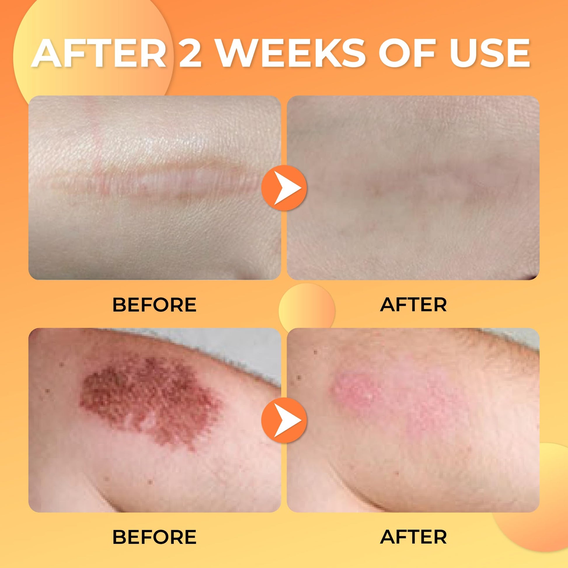 ABERA Scar Removal Cream for Women and Men - Rapid Repair of New Old Scars, Spots, Burns All Natural Treatment with Vitamin E, Alanine, Collagen (1 Box + 3 Eye Patch) - Maple Wellness Supplements