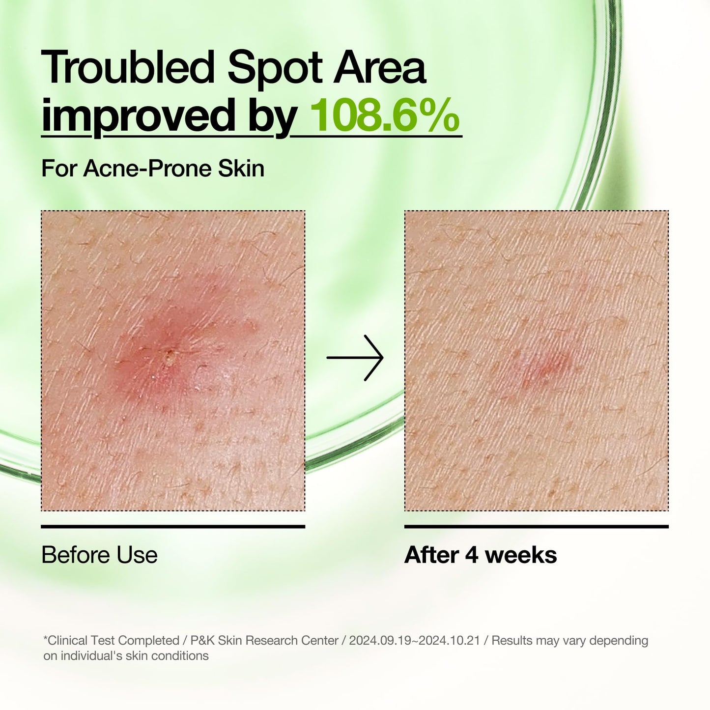 Anua Azelaic Acid 10 Hyaluron Redness Soothing Serum, Facial Serum for Blemish-Prone & Oily-Prone Skin - Maple Wellness Supplements
