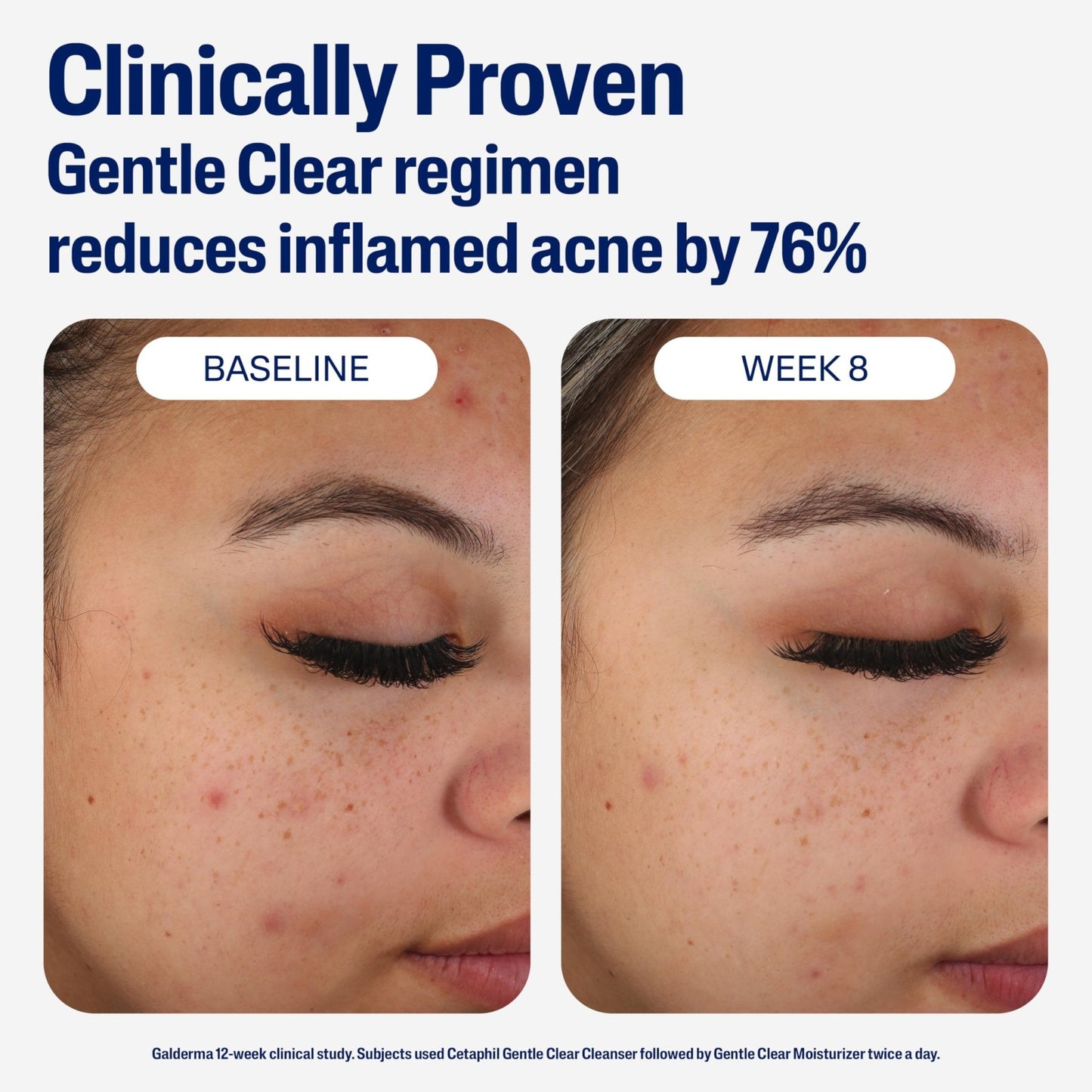 Cetaphil Face Moisturizer, Gentle Clear Mattifying Acne Moisturizer With 0.5% Salicylic Acid - Maple Wellness Supplements
