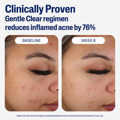Cetaphil Face Moisturizer, Gentle Clear Mattifying Acne Moisturizer With 0.5% Salicylic Acid - Maple Wellness Supplements