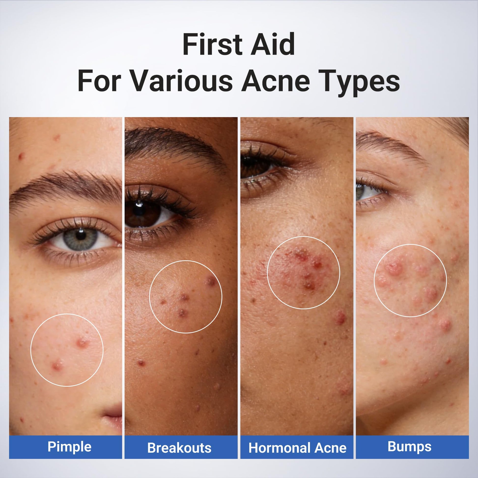 Dr.Leo 1.8% Salicylic Acid Spot Serum, Acne Treatment for Acne-Prone Sensitive Skin | Niacinamide, Fast Pimple Relief, Fades Acne Marks - Maple Wellness Supplements
