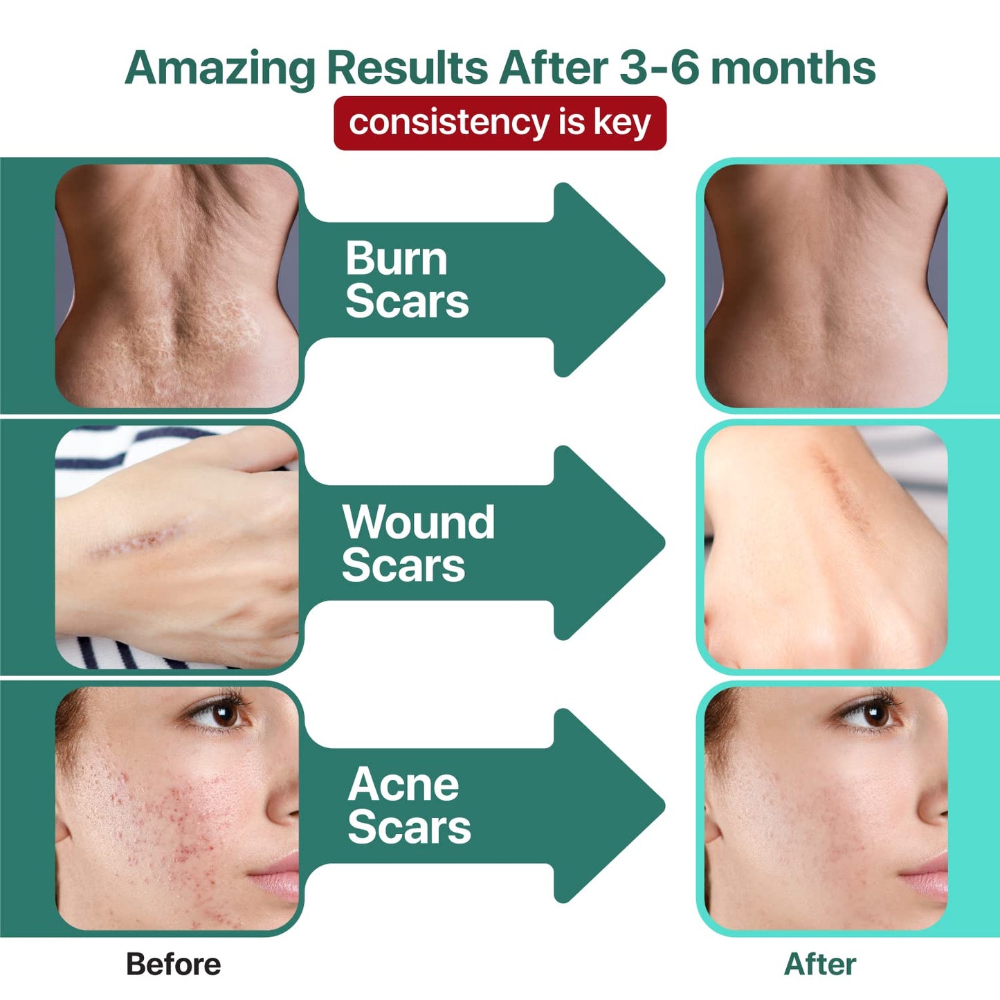 Ebanel Bundle of 30% AHA 2% BHA Chemical Peel and Advanced Silicone Scar Gel - Maple Wellness Supplements