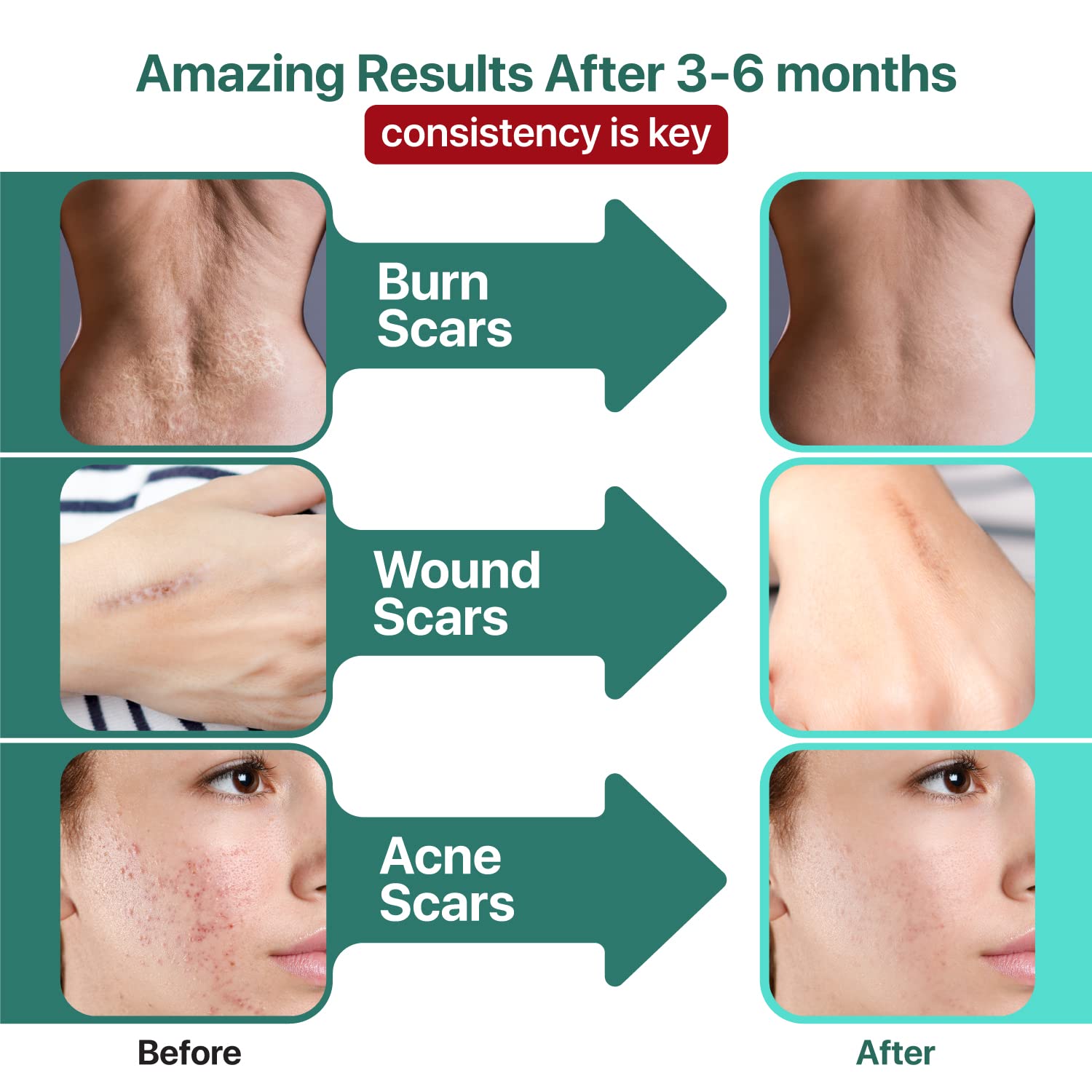 Ebanel Bundle of 30% AHA 2% BHA Chemical Peel and Advanced Silicone Scar Gel - Maple Wellness Supplements