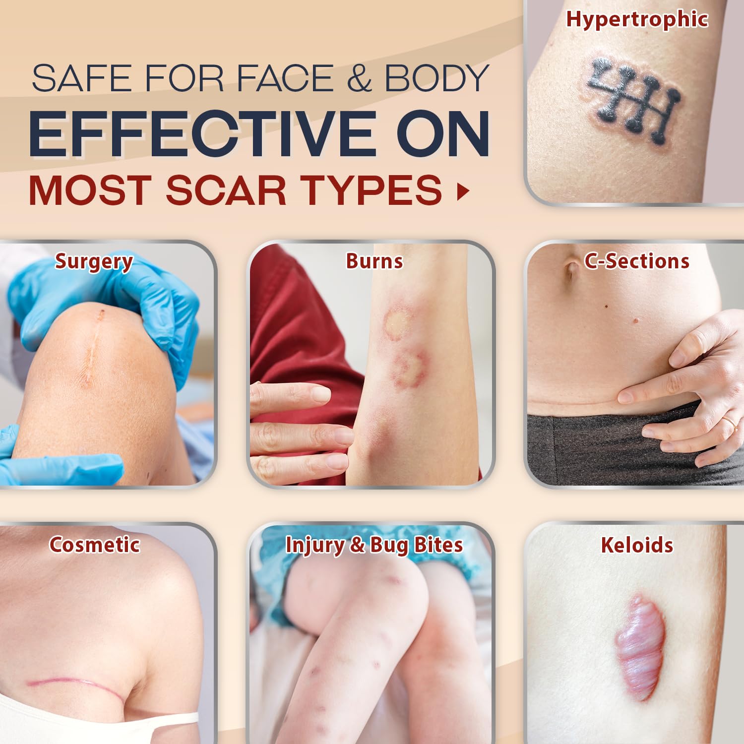 Ebanel Silicone Scar Gel with Allantoin, Emu Oil, Vitamin E and Onion Extract, For Old & New Scars from Surgeries, C-Section, Injuries, Burns & More - Maple Wellness Supplements