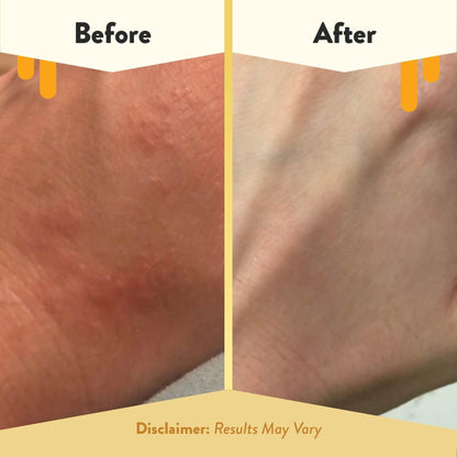 ECZEMA HONEY Oatmeal Body Lotion - Hand & Body Cream for Eczema Relief - Natural Dry Skin Repair (16 Oz) - Maple Wellness Supplements