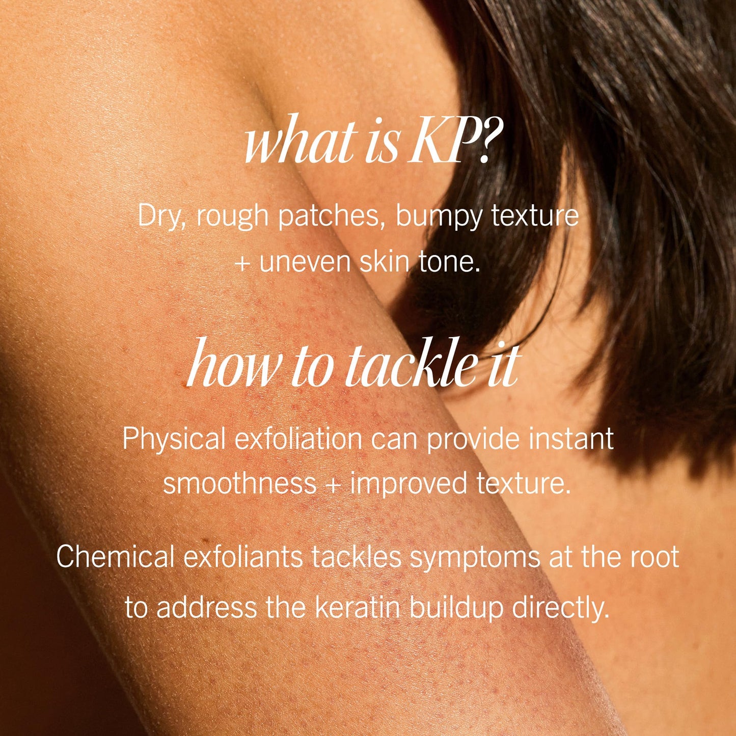 First Aid Beauty - KP Bump Eraser Body Scrub with 10% AHA, Keratosis Pilaris Exfoliator with Glycolic and Lactic acids, Helps Reduce Chicken Skin Bumps - Maple Wellness Supplements