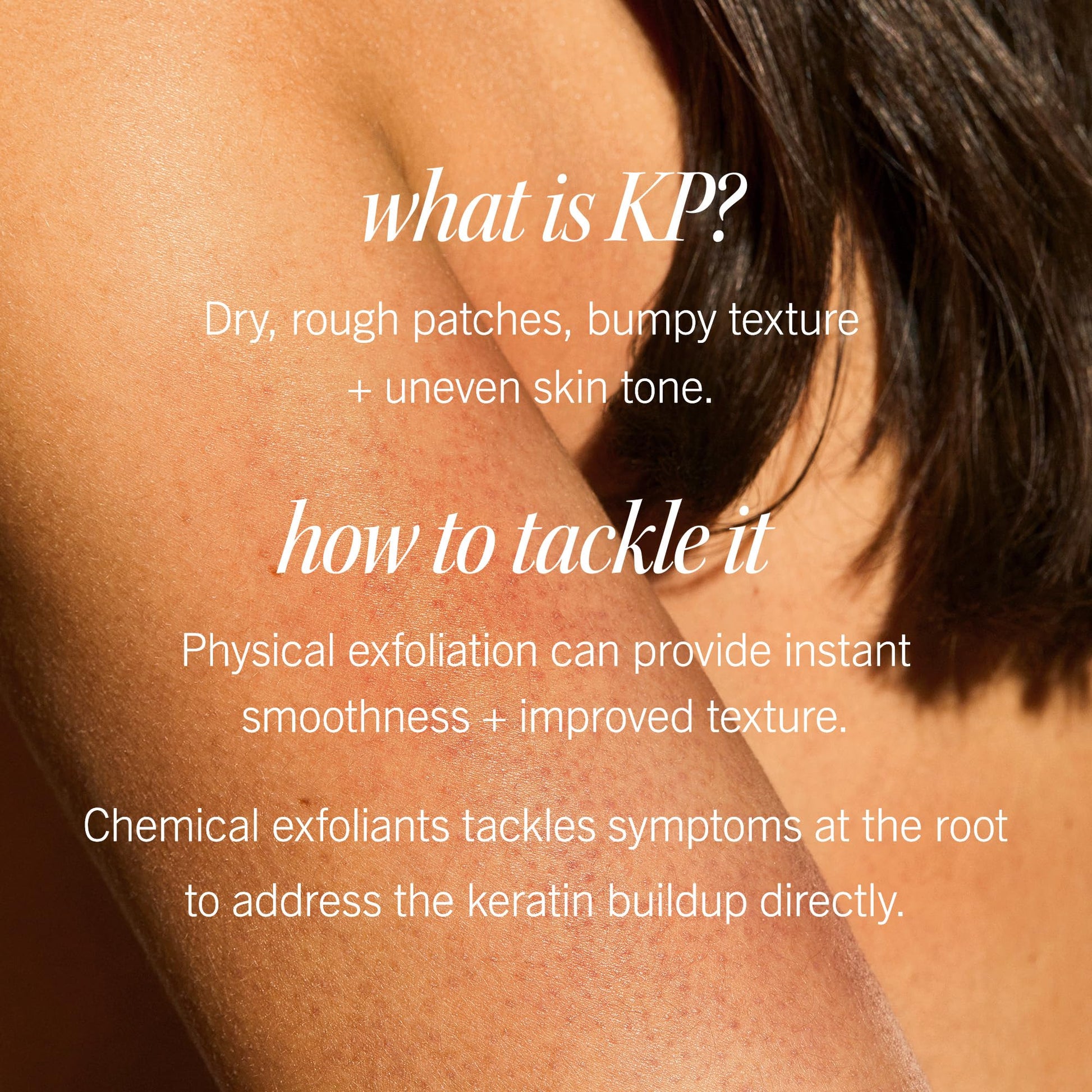 First Aid Beauty - KP Bump Eraser Body Scrub with 10% AHA, Keratosis Pilaris Exfoliator with Glycolic and Lactic acids, Helps Reduce Chicken Skin Bumps - Maple Wellness Supplements