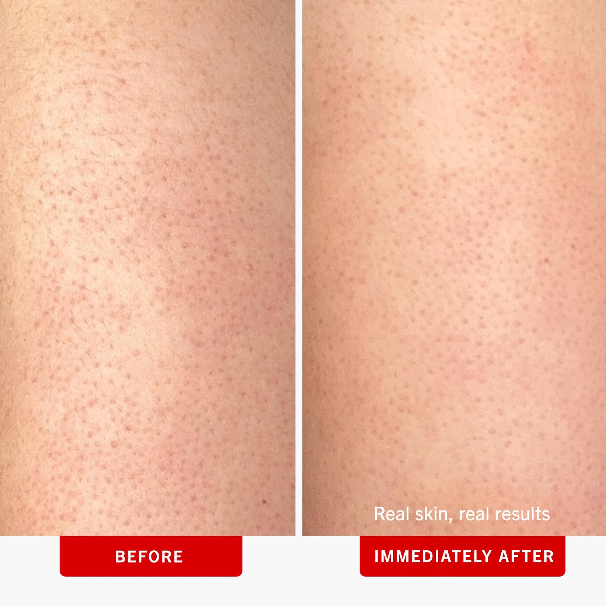 First Aid Beauty - KP Bump Eraser Body Scrub with 10% AHA, Keratosis Pilaris Exfoliator with Glycolic and Lactic acids, Helps Reduce Chicken Skin Bumps - Maple Wellness Supplements