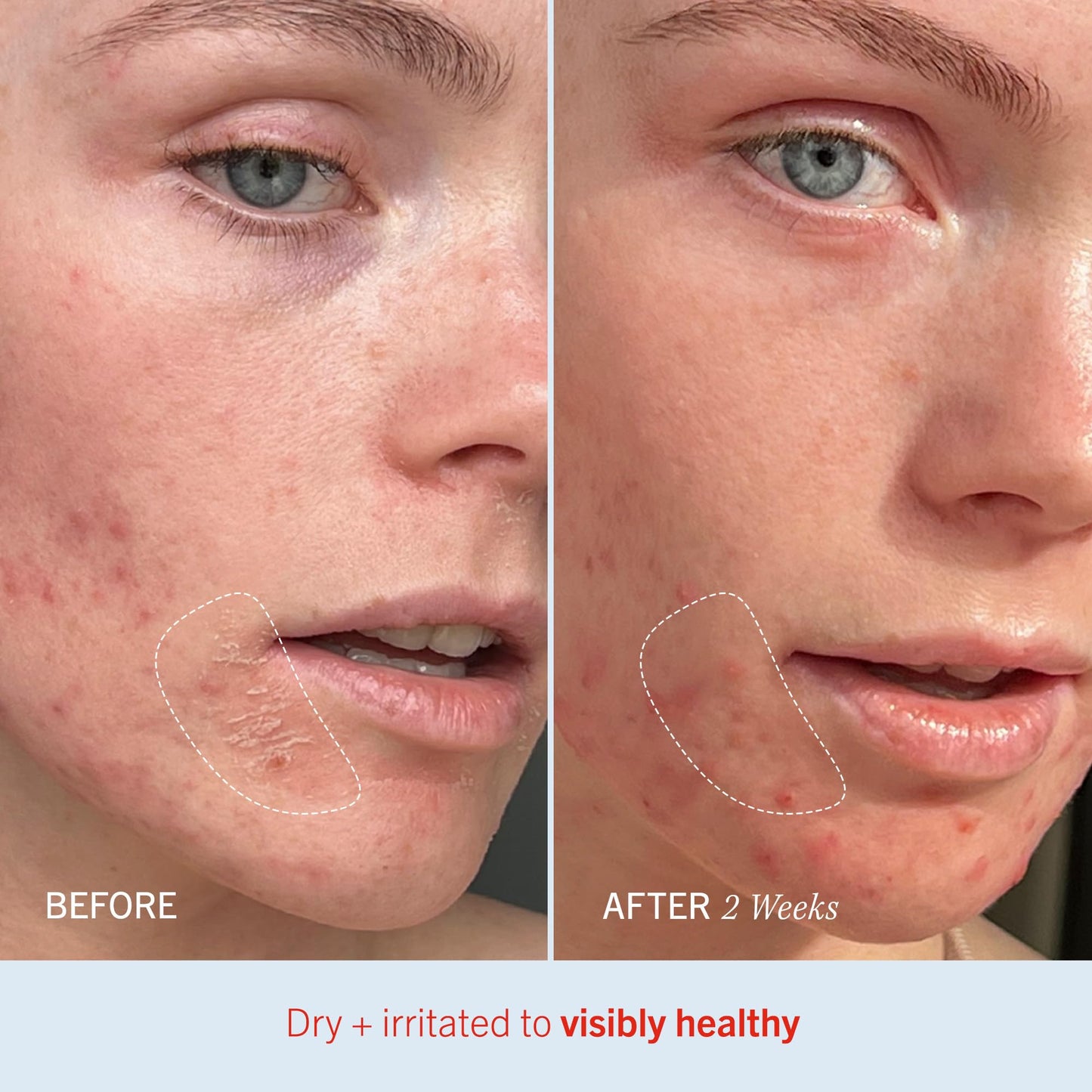 First Aid Beauty - Ultra Repair Cream, Intense Hydration Whipped Colloidal Oatmeal, Clinically Proven to Strengthen Skin Barrier in 7 Days - Maple Wellness Supplements