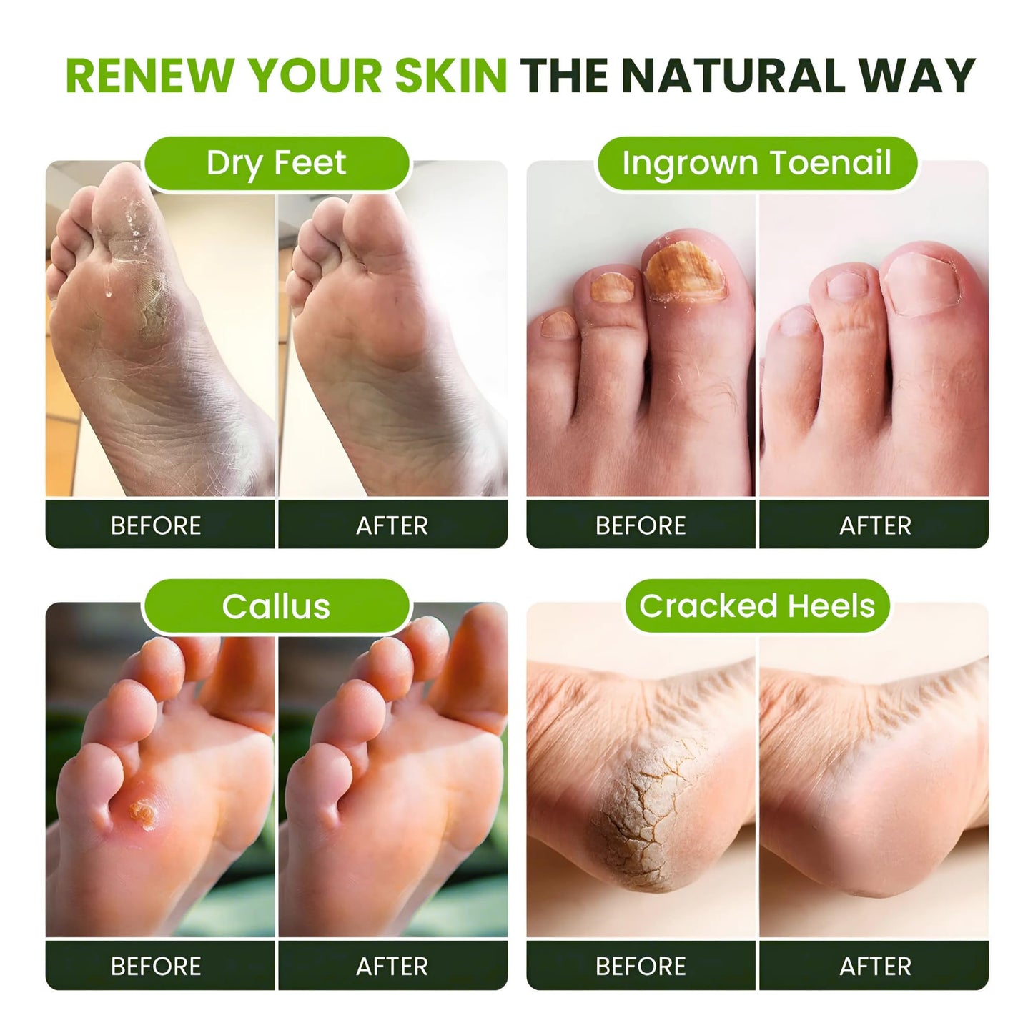 FOOT CURE Tea Tree Oil Foot Soak with Epsom Salt - Best Toenail Fungus Treatment, Athletes Foot & Softens Calluses - Soothes Sore & Tired Feet, Fungal Toe, Foot Odor Scent, Spa Pedicure (Pack of 2) - Maple Wellness Supplements