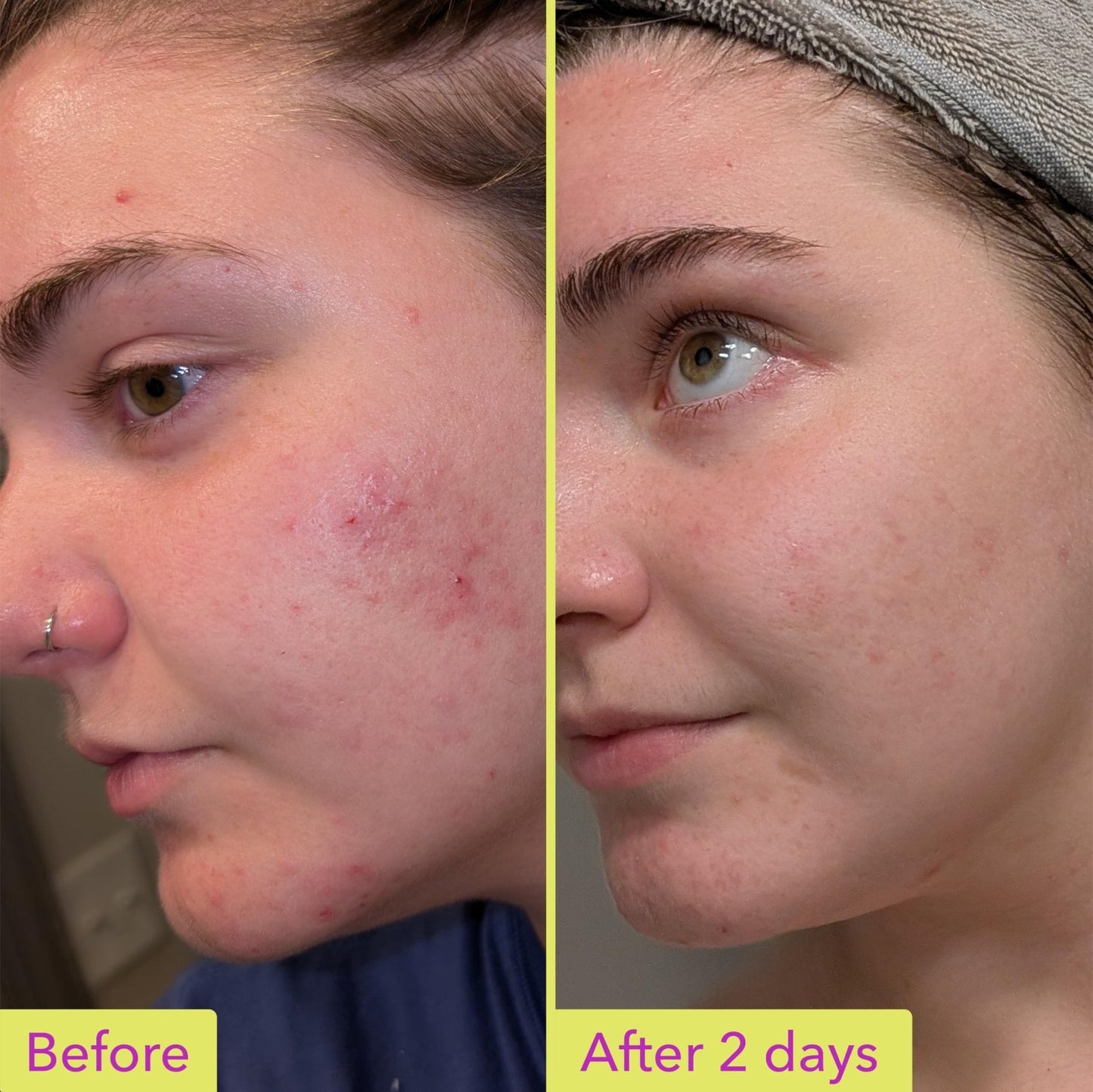 Good Molecules 10% Azelaic Acid Treatment for Face – Soothing Formula for Facial Redness - Maple Wellness Supplements
