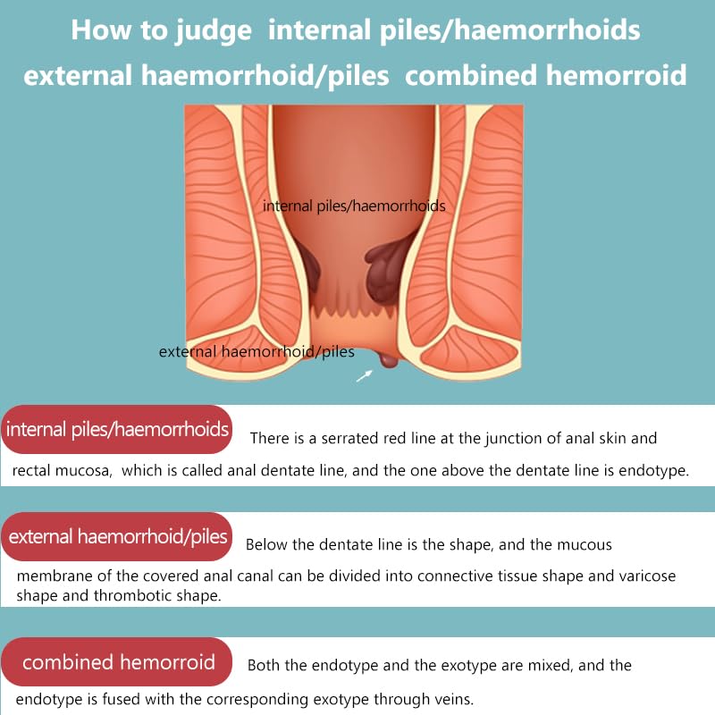 Hemorrhoid Cream for Men and Women, with Lidocaine and Phenylephrine HCl, Provides Fast Relief from hemorrhoid discomfort. Naturally formulated for Hemorrhoids and fissures (0.7 oz) - Maple Wellness Supplements