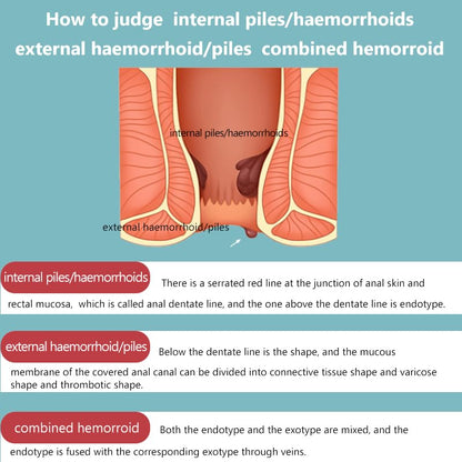 Hemorrhoid Cream for Men and Women, with Lidocaine and Phenylephrine HCl, Provides Fast Relief from hemorrhoid discomfort. Naturally formulated for Hemorrhoids and fissures (0.7 oz) - Maple Wellness Supplements