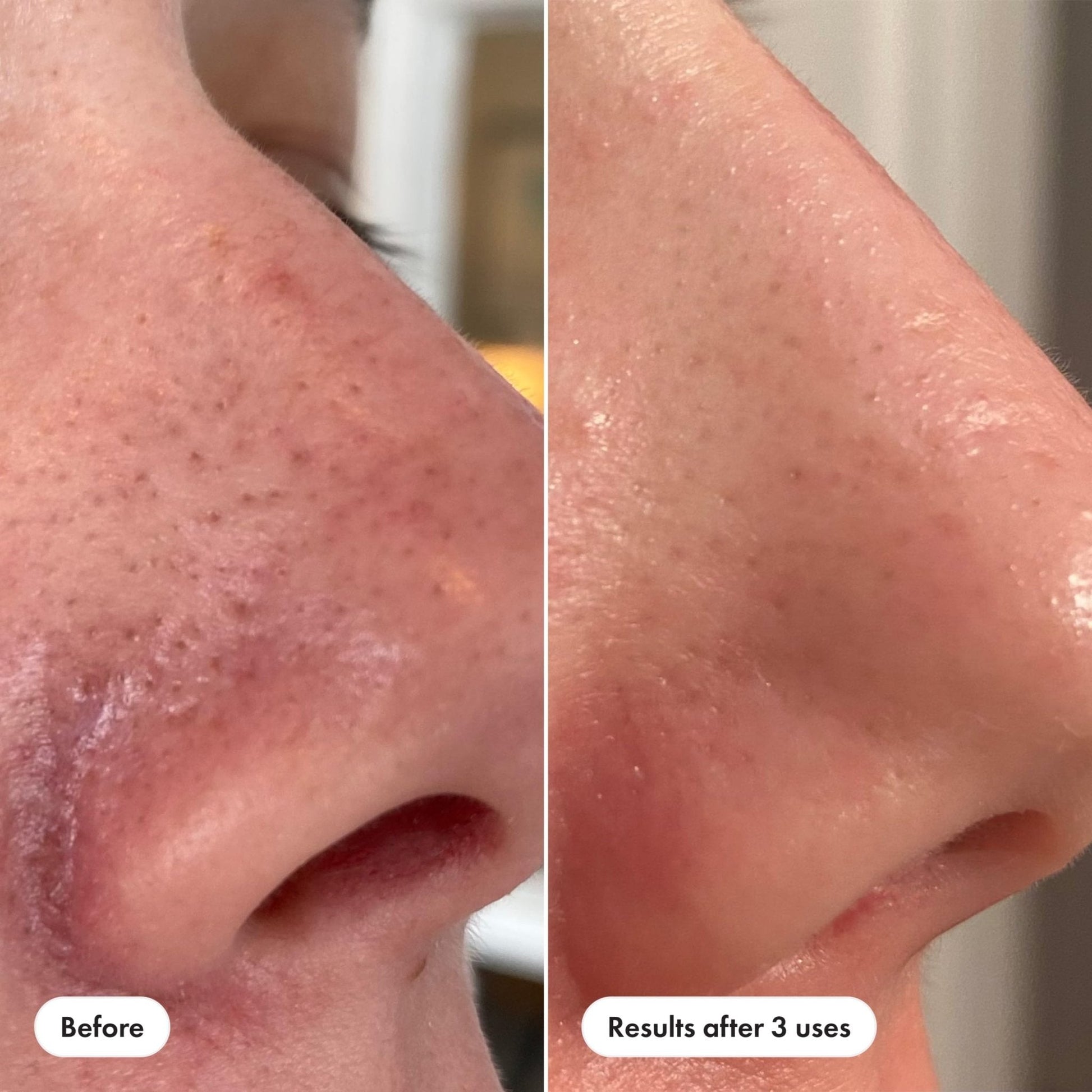 Hero Cosmetics Pore Release Blackhead Clearing Solution, Exfoliating 2% Salicylic Acid Toner Featuring AHA, BHA, and PHA - Maple Wellness Supplements