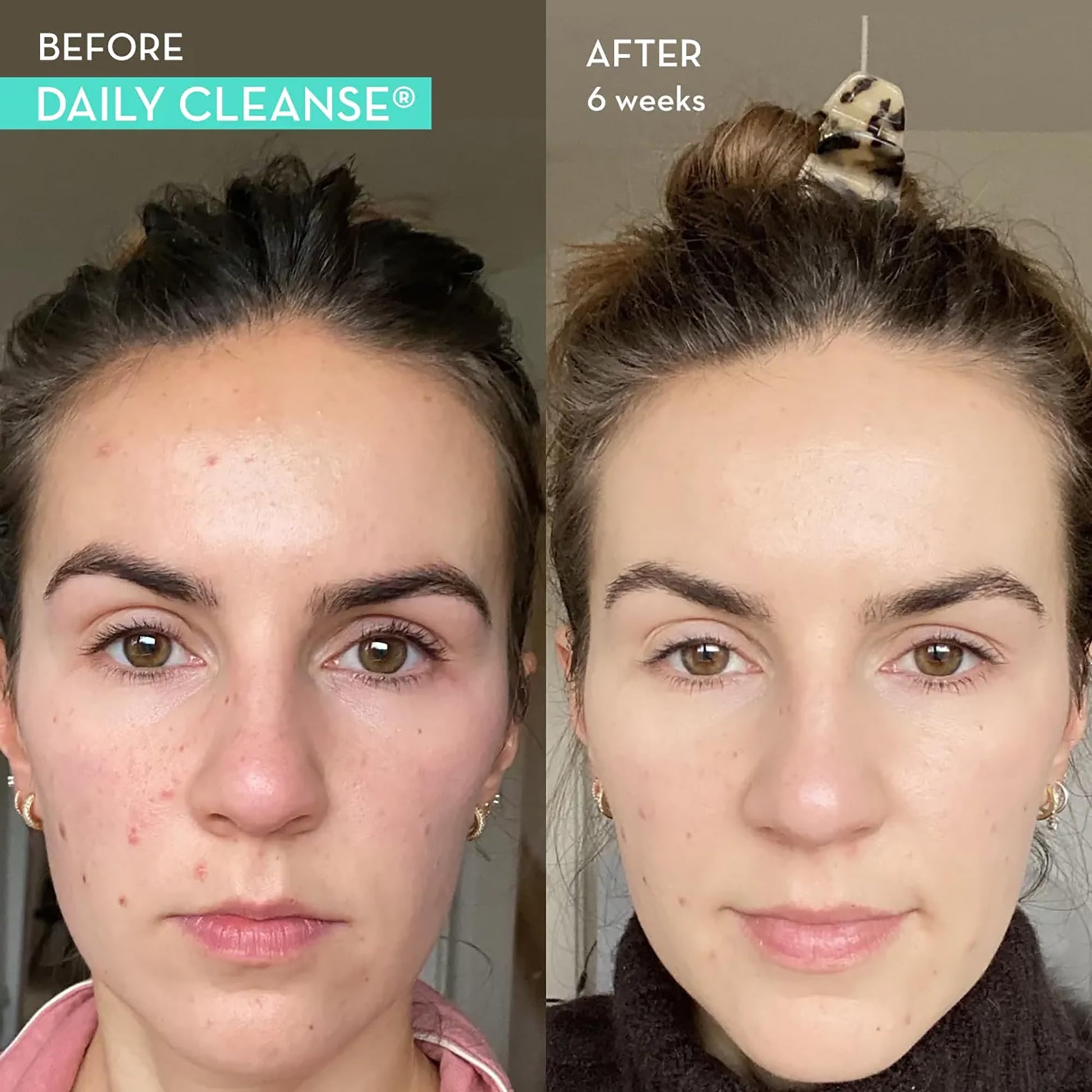 HUM Daily Cleanse Acne Supplements - Support for Clear Skin & Improved Digestion - Maple Wellness Supplements