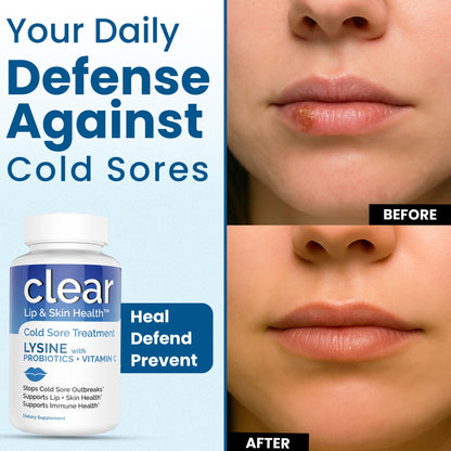 Lysine Cold Sore Treatment for Lips with Pre-Probiotics & VIT C | 1 Month Supply | Supercharged Lysine Capsules with Rhamnosus & Acidophilus for Cold Sores Relief - Maple Wellness Supplements
