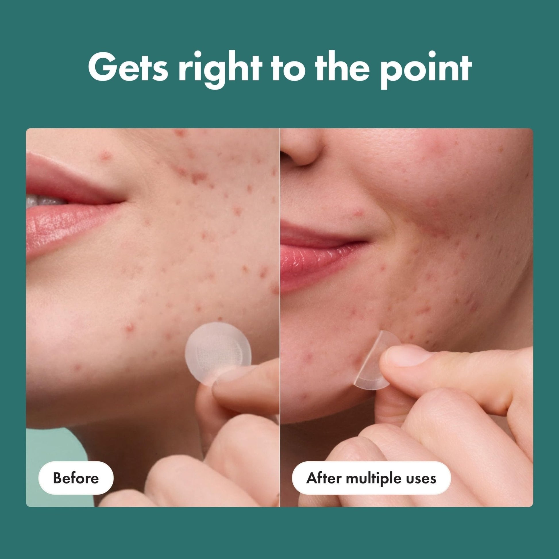 Mighty Patch Micropoint Large Hydrocolloid Pimple Patches for Face Blemishes from Hero Cosmetics, Acne Stickers for Early Stage Zits - Maple Wellness Supplements