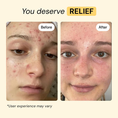 MyMagicHealer Thyme & Tea Tree Flare Care | Cystic Acne, Folliculitis, Ingrown Hair, Keratosis Pilaris, Razor Bumps, Body Bumps, Blind Pimples Multi-purpose Solution - Maple Wellness Supplements
