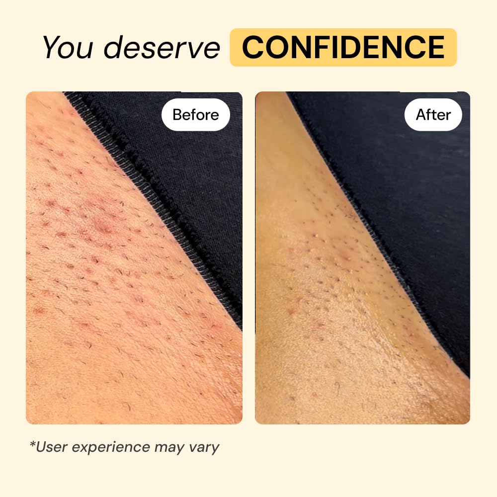 MyMagicHealer Thyme & Tea Tree Flare Care | Cystic Acne, Folliculitis, Ingrown Hair, Keratosis Pilaris, Razor Bumps, Body Bumps, Blind Pimples Multi-purpose Solution - Maple Wellness Supplements