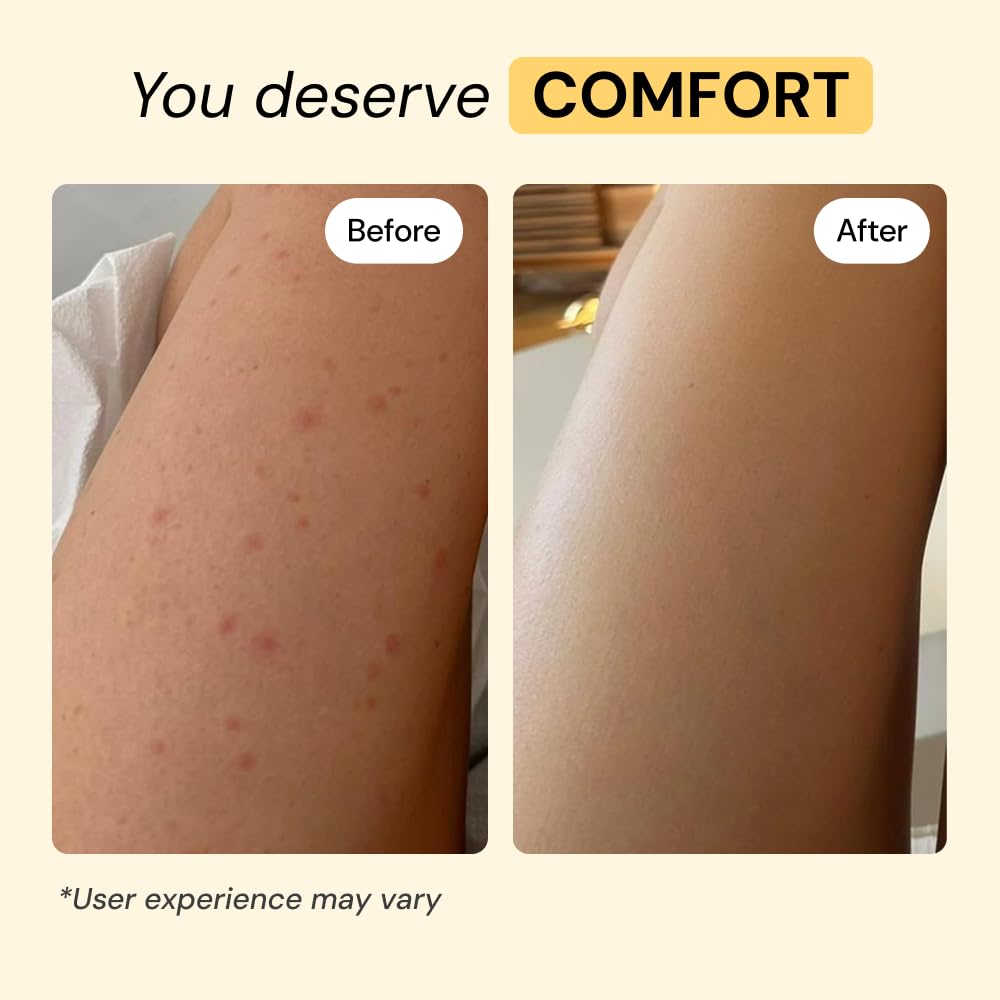 MyMagicHealer Thyme & Tea Tree Flare Care | Cystic Acne, Folliculitis, Ingrown Hair, Keratosis Pilaris, Razor Bumps, Body Bumps, Blind Pimples Multi-purpose Solution - Maple Wellness Supplements