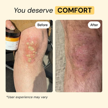 MyMagicHealer Universal Flare Care | Essential Oil Free | Baby Dermatitis, Diaper Rash, Eczema, Psoriasis, Impetigo | Wound Car - Maple Wellness Supplements