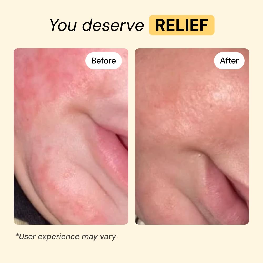 MyMagicHealer Universal Flare Care | Essential Oil Free | Baby Dermatitis, Diaper Rash, Eczema, Psoriasis, Impetigo | Wound Car - Maple Wellness Supplements
