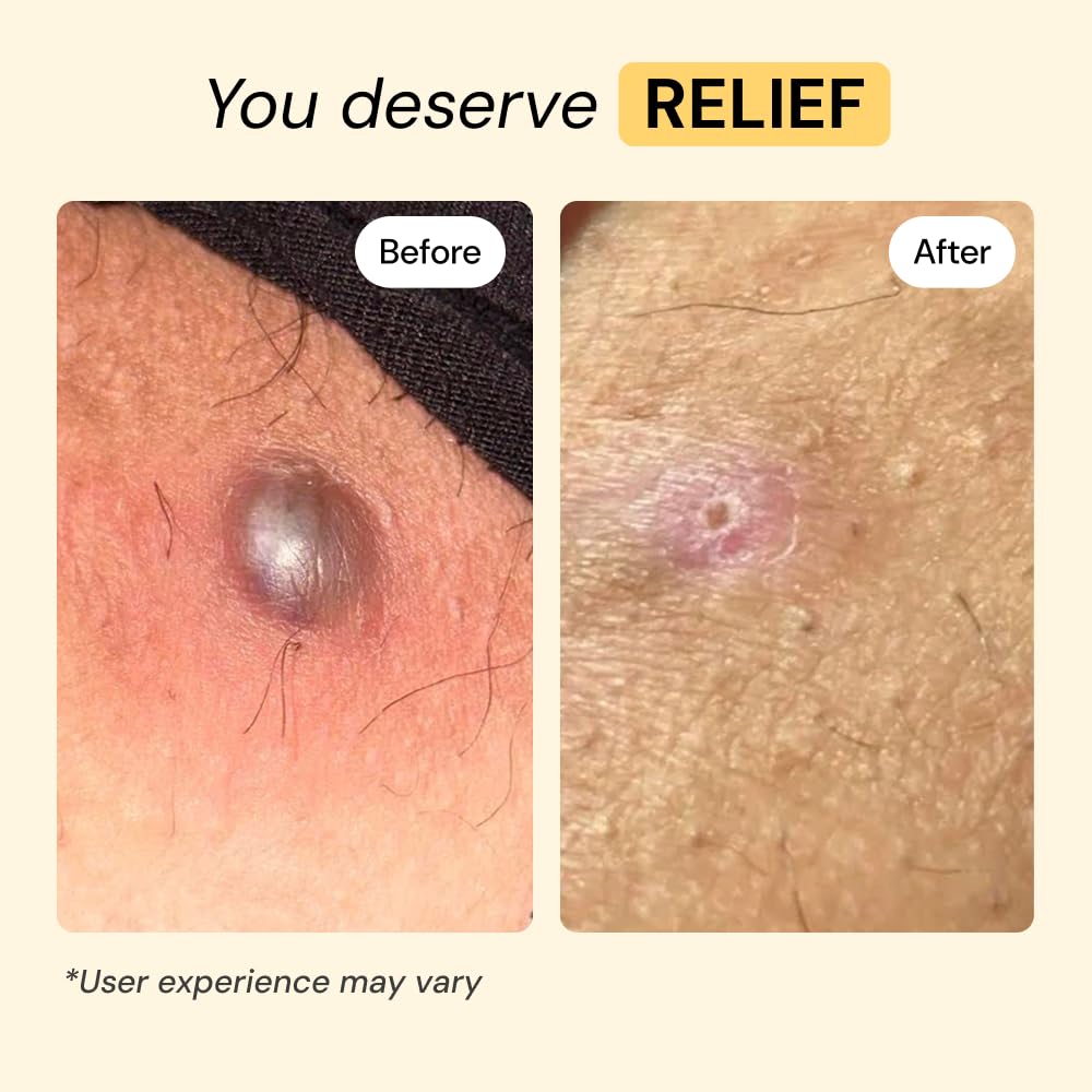 MyMagicHealer Universal Flare Care – Multi-Purpose Solution | Skin Flare-Ups - Hidradenitis Suppurativa, Folliculitis, Boils, Cysts - Maple Wellness Supplements