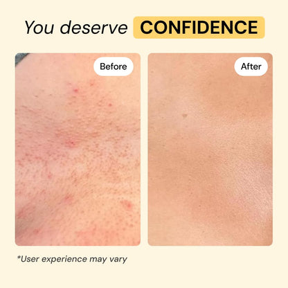 MyMagicHealer Universal Flare Care – Multi-Purpose Solution | Skin Flare-Ups - Hidradenitis Suppurativa, Folliculitis, Boils, Cysts - Maple Wellness Supplements