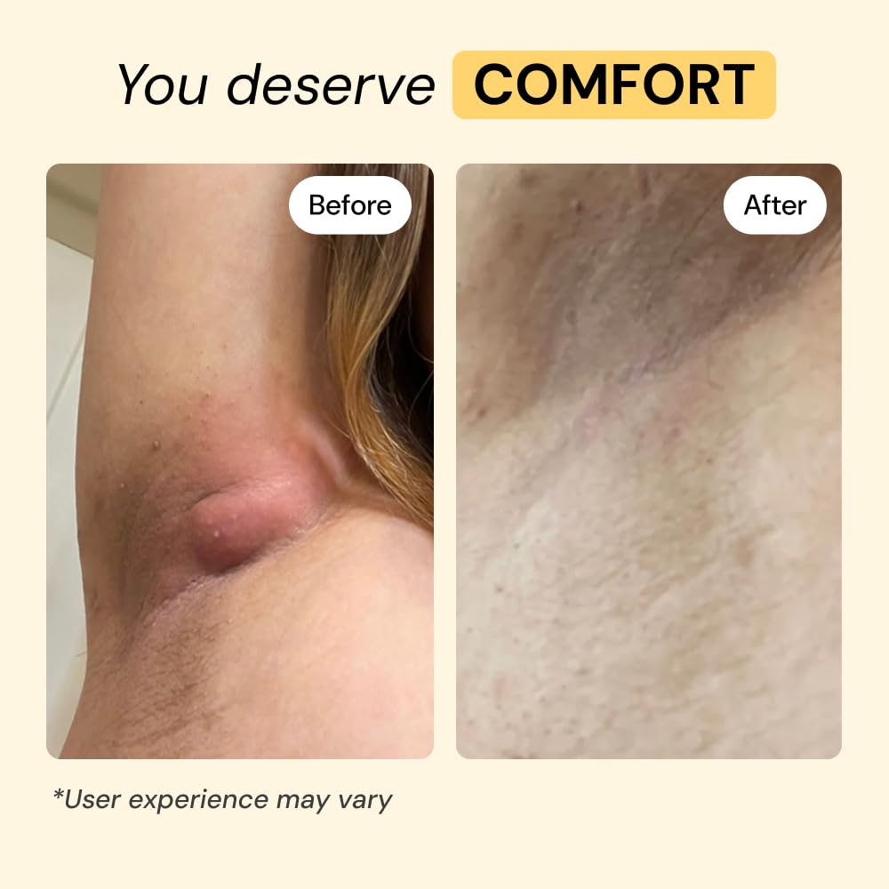 MyMagicHealer Universal Flare Care – Multi-Purpose Solution | Skin Flare-Ups - Hidradenitis Suppurativa, Folliculitis, Boils, Cysts - Maple Wellness Supplements