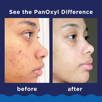PanOxyl 10% Benzoyl Peroxide Acne Foaming Wash, Maximum Strength, Daily Acne-Fighting - Maple Wellness Supplements